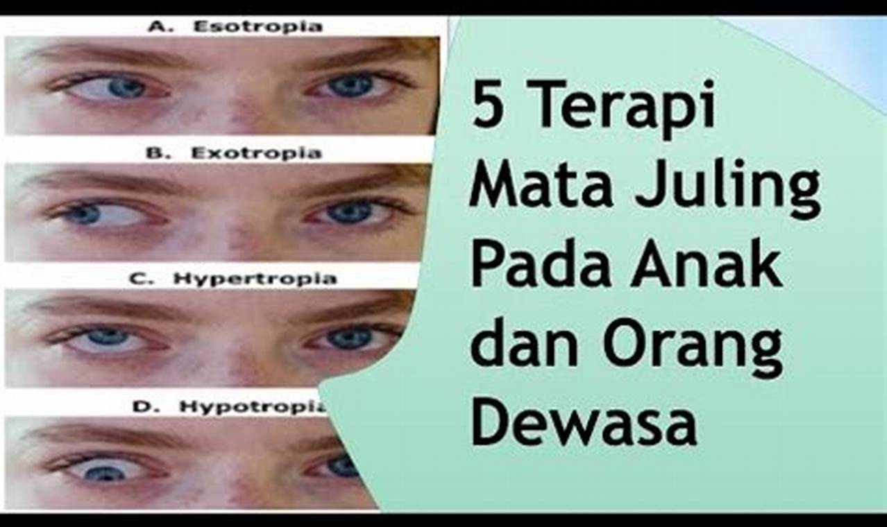 Cara Mengatasi Mata Juling